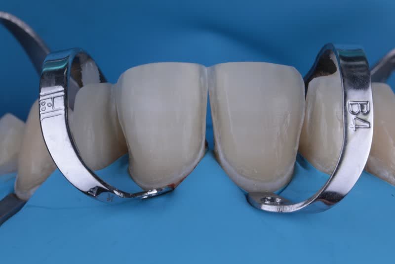 Détail prothèse dentaire