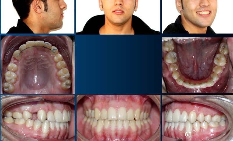 Cas orthodontique avant/après