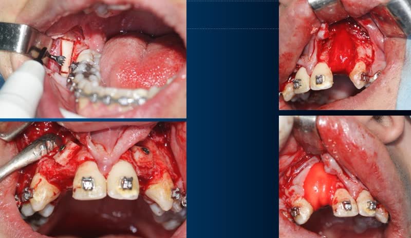 Chirurgie implantaire