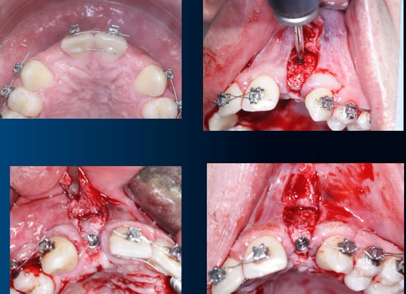 Chirurgie implantaire