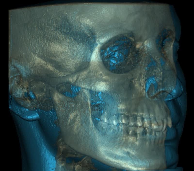 Scanner 3D crânien