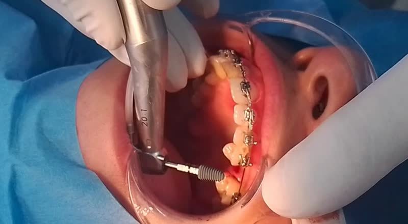 Détail intra-oral implant