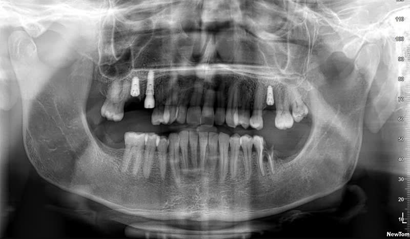 Radiographie panoramique